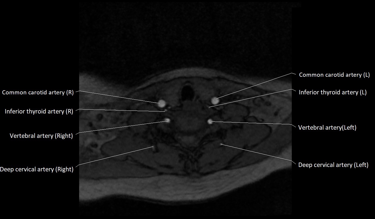 Carotid artery anatomy axial 3T image 55.jpg